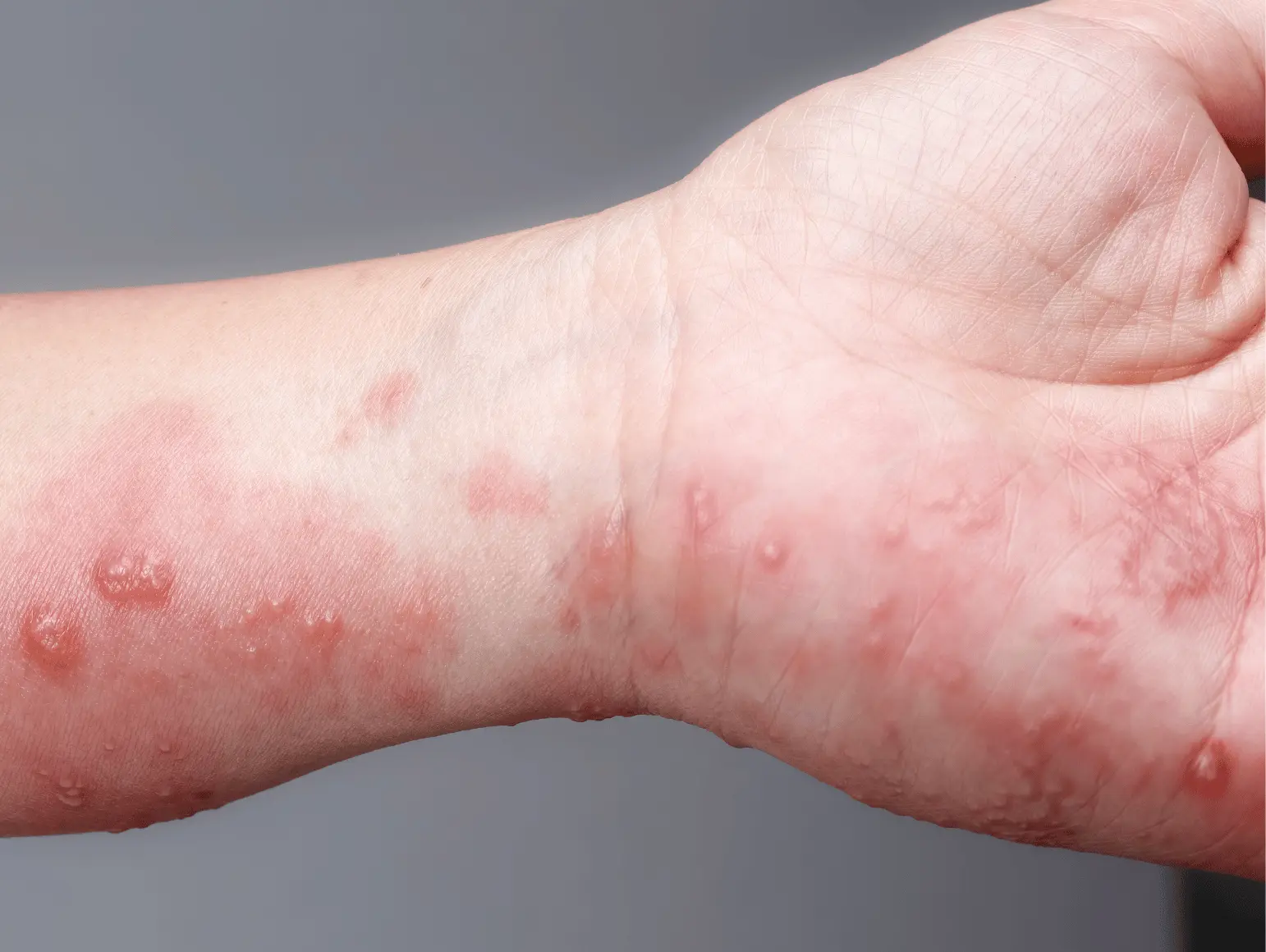 Secuelas del Herpes Zóster en Adultos Mayores: Previene a tiempo el Virus